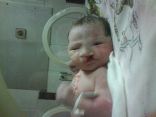 Karlička - dítě s rozštěpem