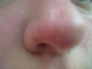 Flek na nose. Co s ním?